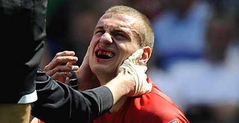 Nemanja Vidic bleeding from his nose and teeth, at a football/soccer game for Man Utd