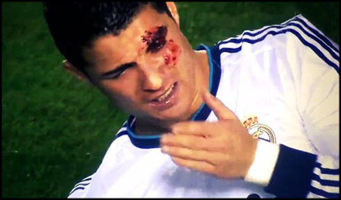 Cristiano Ronaldo injury, bleeding from his eye and left eyebrow, after being elbowed in Levante vs Real Madrid, for La Liga 2012-2013