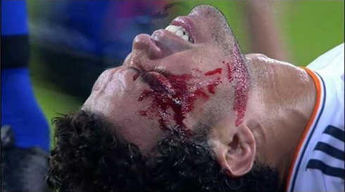 Pepe big cut and bleeding from an injury on his head, in Real Madrid vs Copenhagen, in 2013-2014