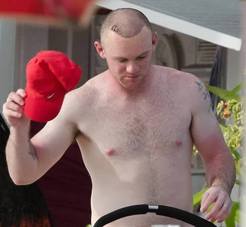 Wayne Rooney looks after his hair transplant, still with no hair and bald