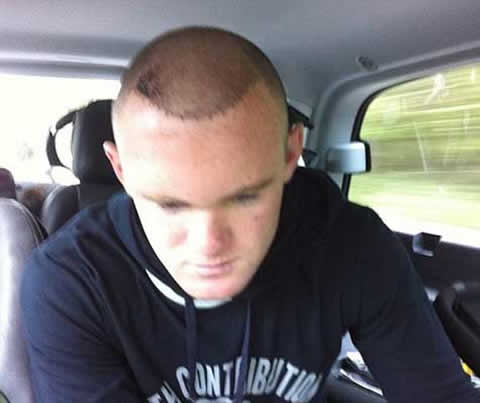 Wayne Rooney head, just after his hair surgery and transplant