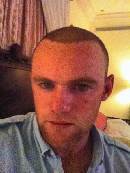Wayne Rooney photo from his head just after had surgery and after the hair transplantation, still with no visible growth