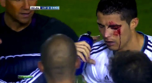 Cristiano Ronaldo covered in blood during Levante vs Real Madrid for La Liga 2012-2013, after taking an elbow on his left eye