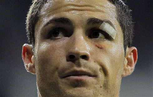 Cristiano Ronaldo playing with his injured left black eye, in Real Madrid vs Athletic Bilbao for La Liga in 2012-2013