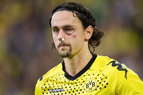 Neven Subotić, football player with his face in a total wreck, during a game for Borussia Dortmund