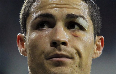 Cristiano Ronaldo nasty black eye injury, still looking bad one week after