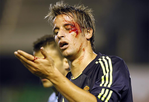 Fábio Coentrão bleeding from his left eye, after picking an injury in Betis vs Real Madrid, for La Liga 2012-2013