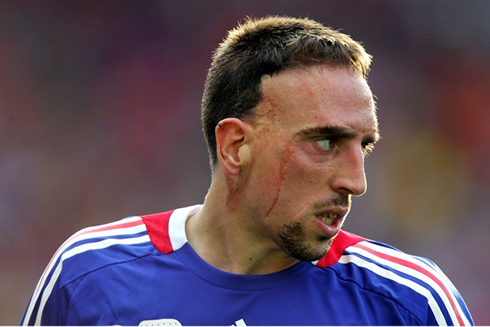 Franck Ribery scar on his face