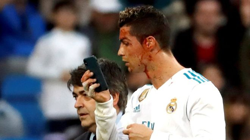 Cristiano Ronaldo bleeding from his face uses a mobile phone to watch himself in the mirror